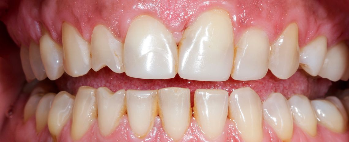 Crowns and Veneers Before