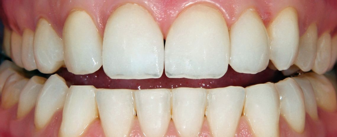 Teeth Straightening and Whitening After